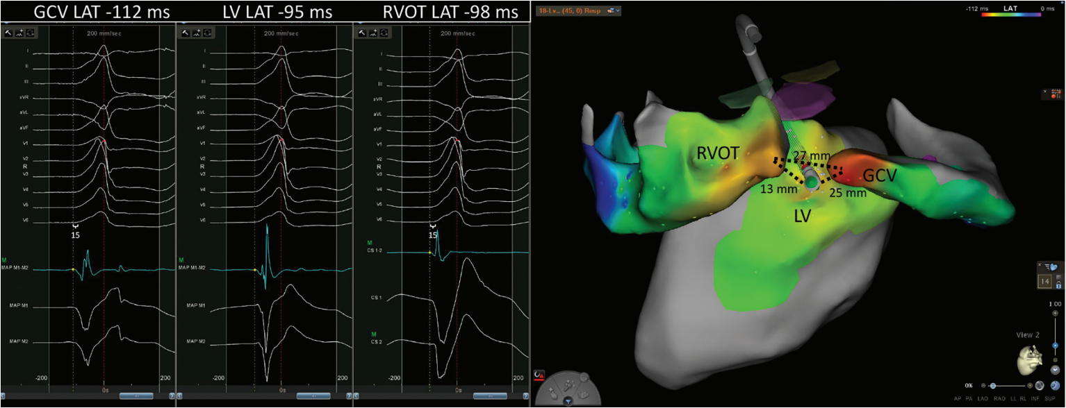 【M8号】Growing heart View From the Left Ventricular Summit: Endocardial Ablation of